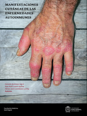 cover image of Manifestaciones cutáneas de las enfermedades autoinmunes